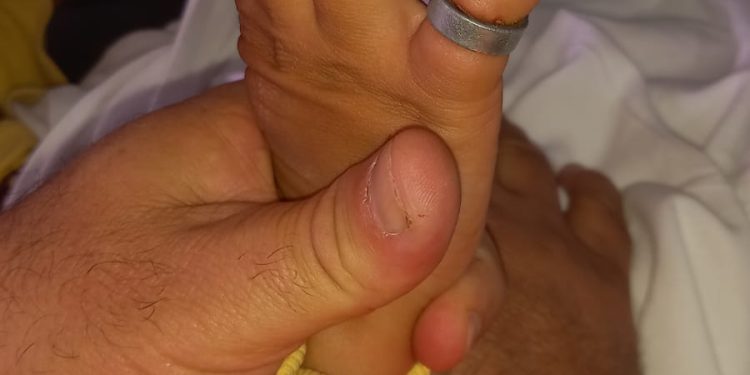 Bombeiros atendem criança com rolamento de aço preso no dedo