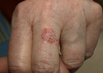 Minas Gerais registrou mais de 14,9 mil casos de hanseníase nos últimos 10 anos.